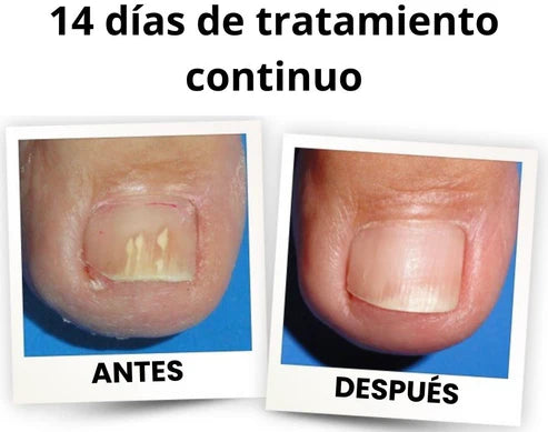PARCHES ANTI-HONGOS 100% ORIGINAL (EVITA IMITACIONES)