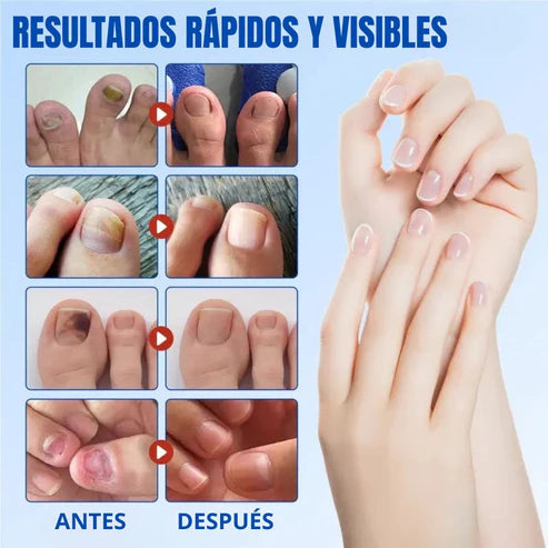 PARCHES ANTI-HONGOS 100% ORIGINAL (EVITA IMITACIONES)